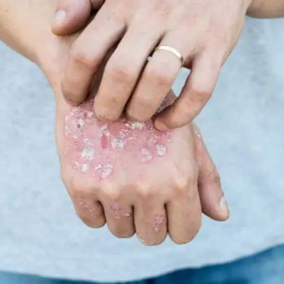 skin infection2 (1)